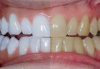3 Cosas que puedes mezclar para conseguir unos dientes Blancos y eliminar las manchas